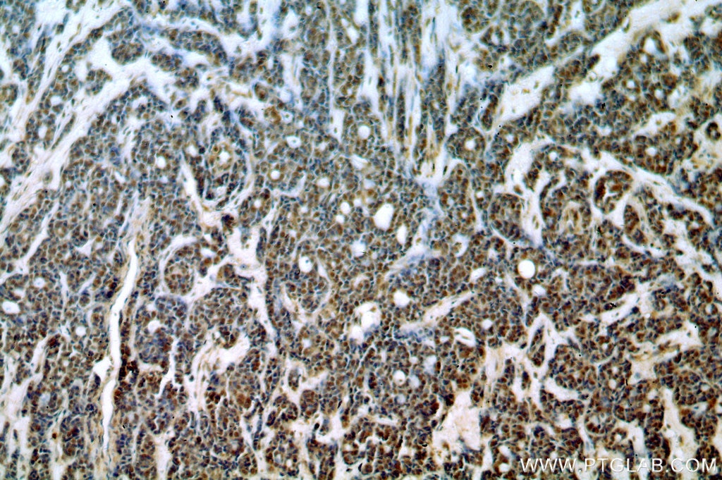 Immunohistochemistry (IHC) staining of human cervical cancer tissue using SAP18 Polyclonal antibody (13841-1-AP)