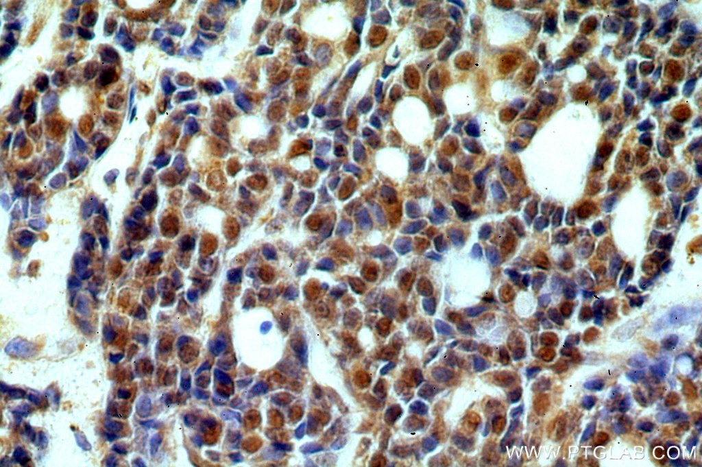 Immunohistochemistry (IHC) staining of human cervical cancer tissue using SAP18 Polyclonal antibody (13841-1-AP)