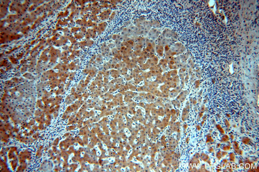 Immunohistochemistry (IHC) staining of human hepatocirrhosis tissue using SAR1A Polyclonal antibody (15350-1-AP)