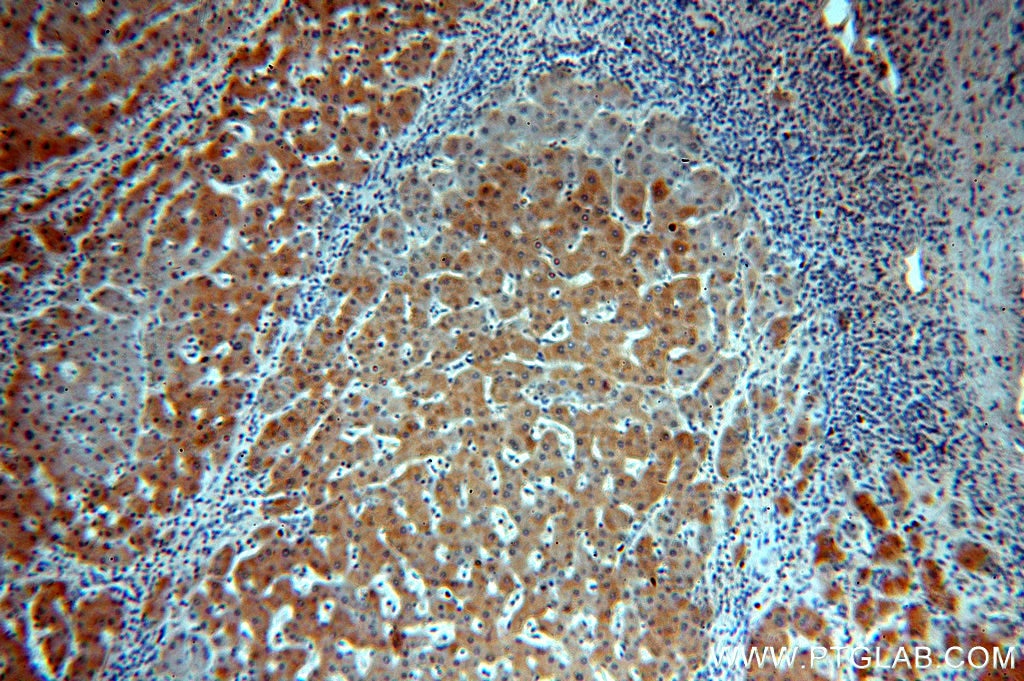 IHC staining of human hepatocirrhosis using 15350-1-AP