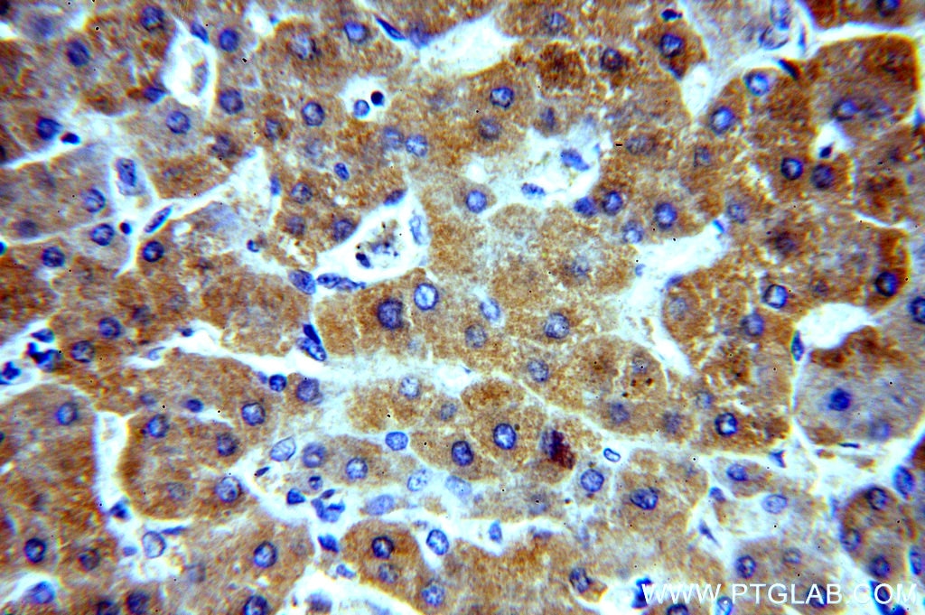 Immunohistochemistry (IHC) staining of human hepatocirrhosis tissue using SAR1A Polyclonal antibody (15350-1-AP)