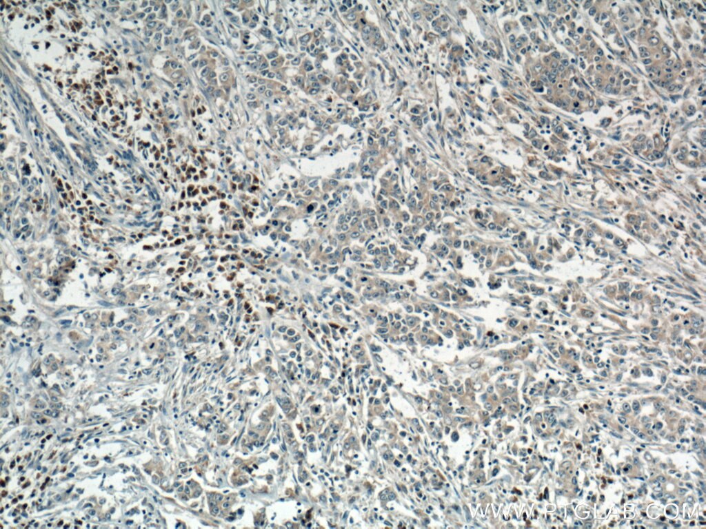 Immunohistochemistry (IHC) staining of human stomach cancer tissue using SAR1B Polyclonal antibody (15453-1-AP)