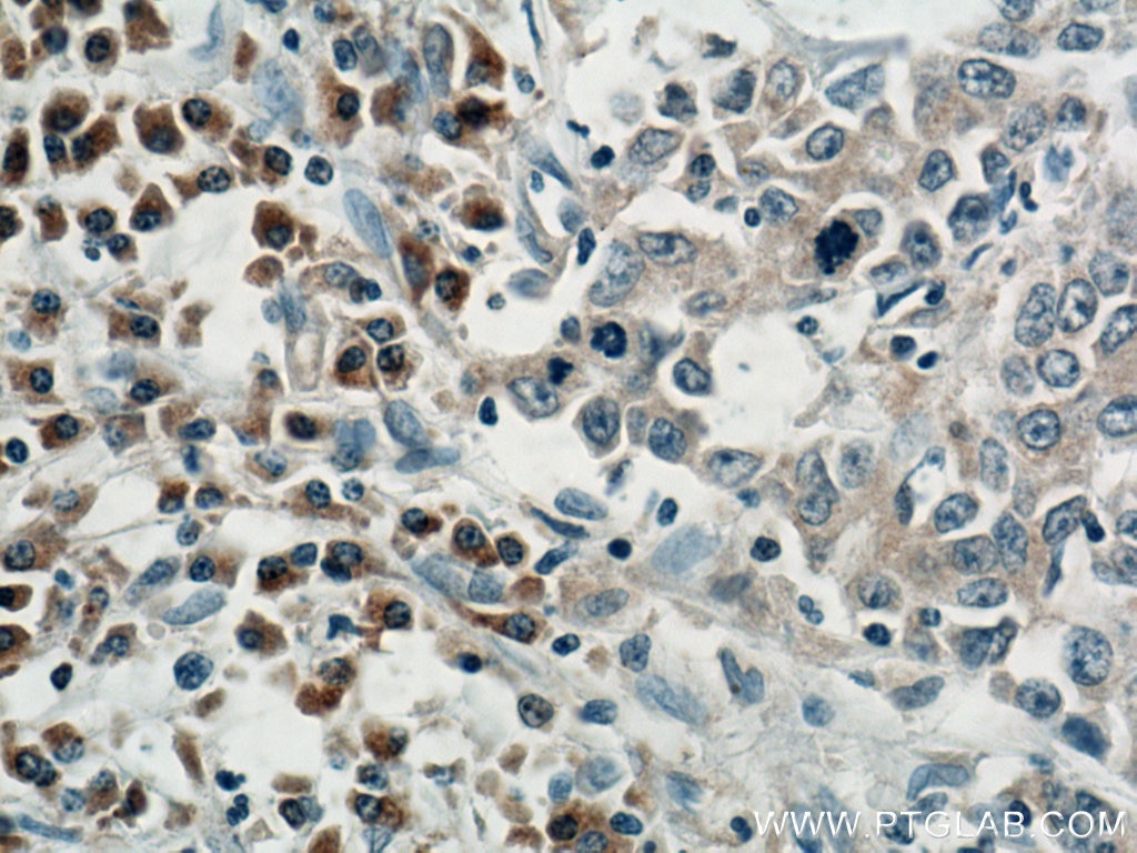 Immunohistochemistry (IHC) staining of human stomach cancer tissue using SAR1B Polyclonal antibody (15453-1-AP)