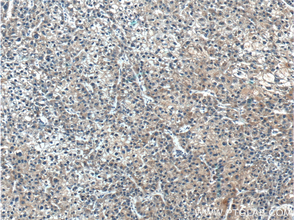 Immunohistochemistry (IHC) staining of human liver cancer tissue using SARDH Polyclonal antibody (22762-1-AP)