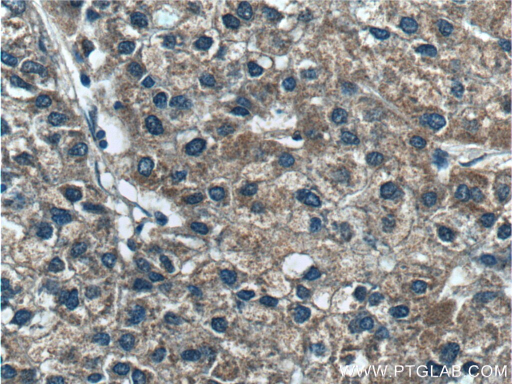 Immunohistochemistry (IHC) staining of human liver cancer tissue using SARDH Polyclonal antibody (22762-1-AP)