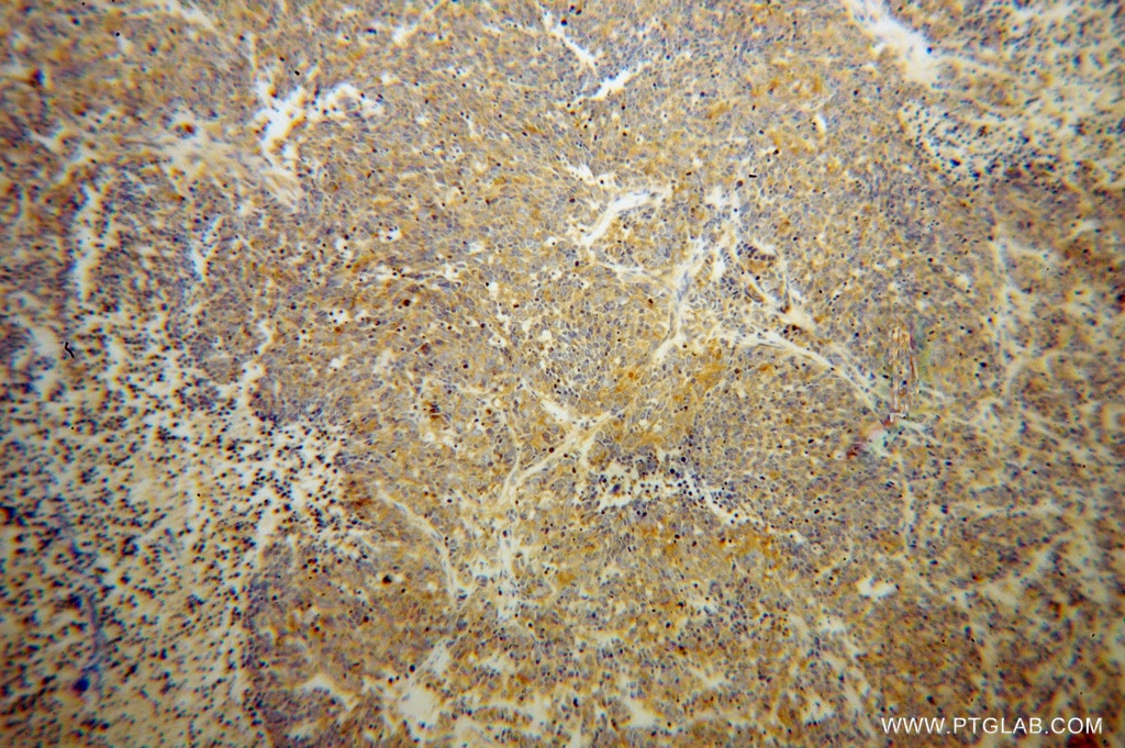 Immunohistochemistry (IHC) staining of human lung cancer tissue using SARS Polyclonal antibody (15162-1-AP)