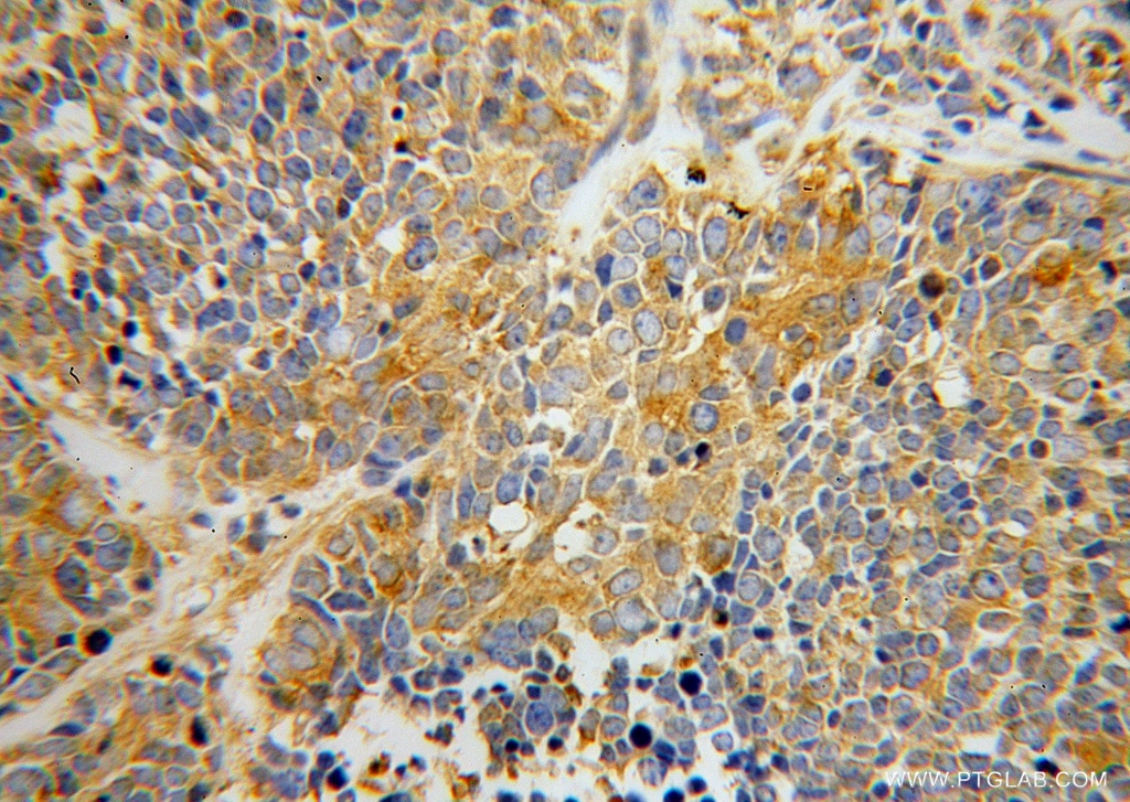 Immunohistochemistry (IHC) staining of human lung cancer tissue using SARS Polyclonal antibody (15162-1-AP)