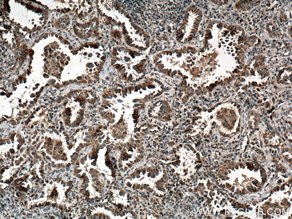 Immunohistochemistry (IHC) staining of human lung cancer tissue using SARS2 Polyclonal antibody (17258-1-AP)