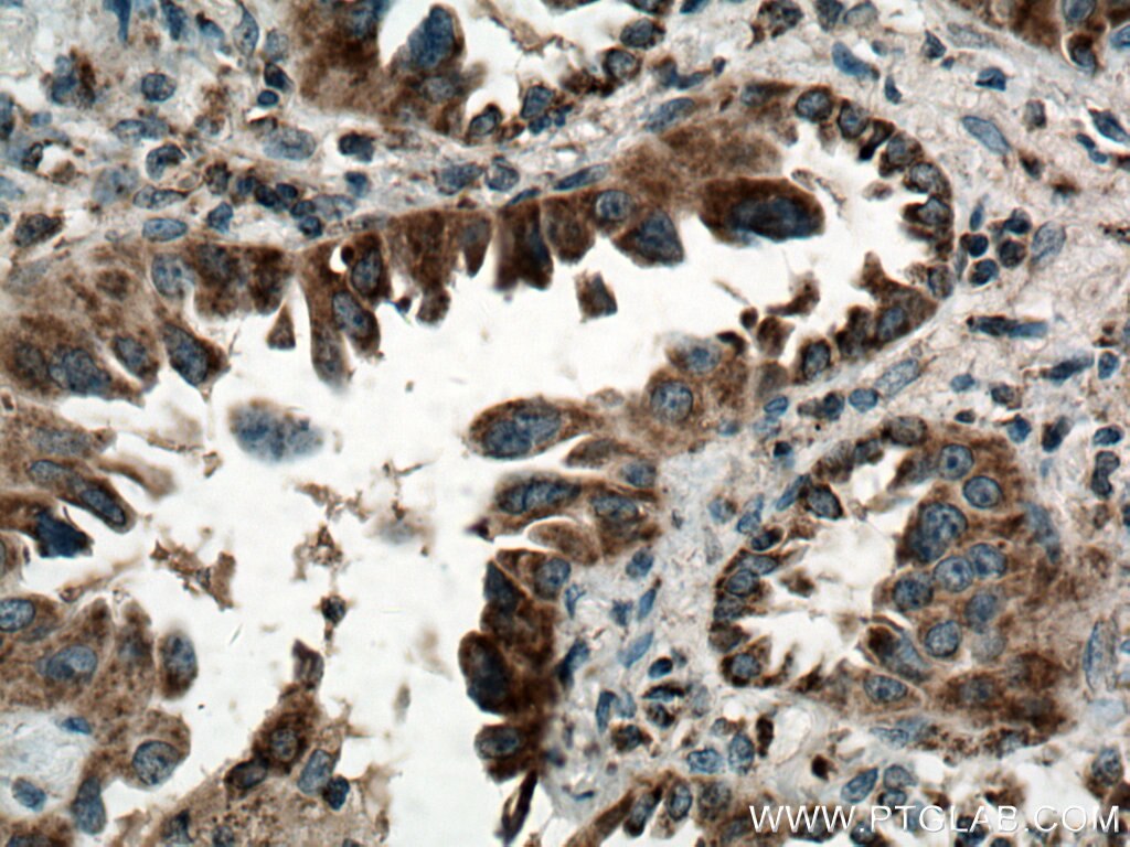 Immunohistochemistry (IHC) staining of human lung cancer tissue using SARS2 Polyclonal antibody (17258-1-AP)
