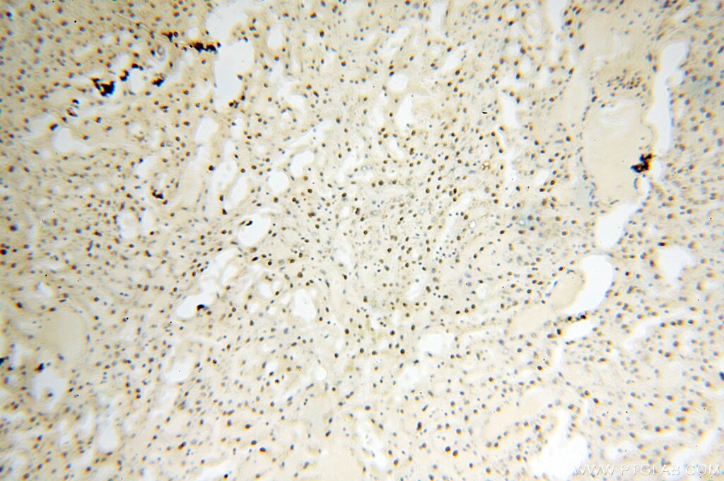 Immunohistochemistry (IHC) staining of human liver tissue using SART3 Polyclonal antibody (18025-1-AP)