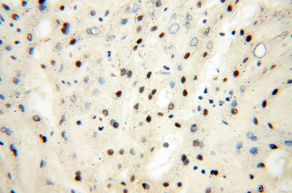 Immunohistochemistry (IHC) staining of human liver tissue using SART3 Polyclonal antibody (18025-1-AP)