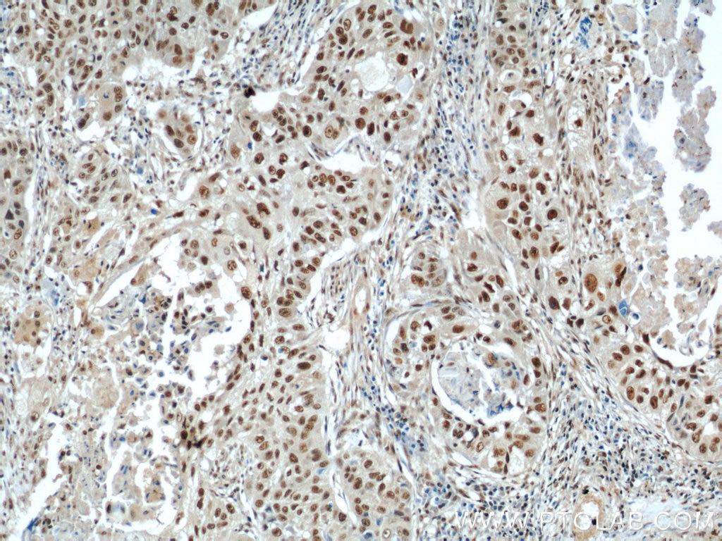 Immunohistochemistry (IHC) staining of human lung cancer tissue using SART3 Polyclonal antibody (18025-1-AP)