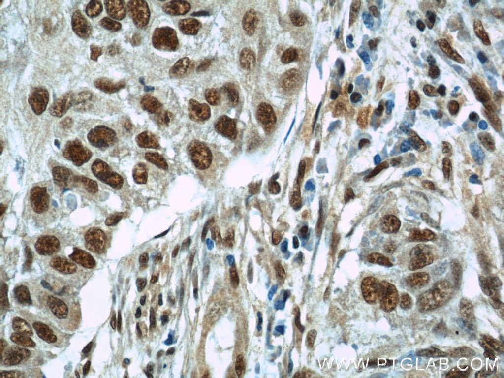 Immunohistochemistry (IHC) staining of human lung cancer tissue using SART3 Polyclonal antibody (18025-1-AP)