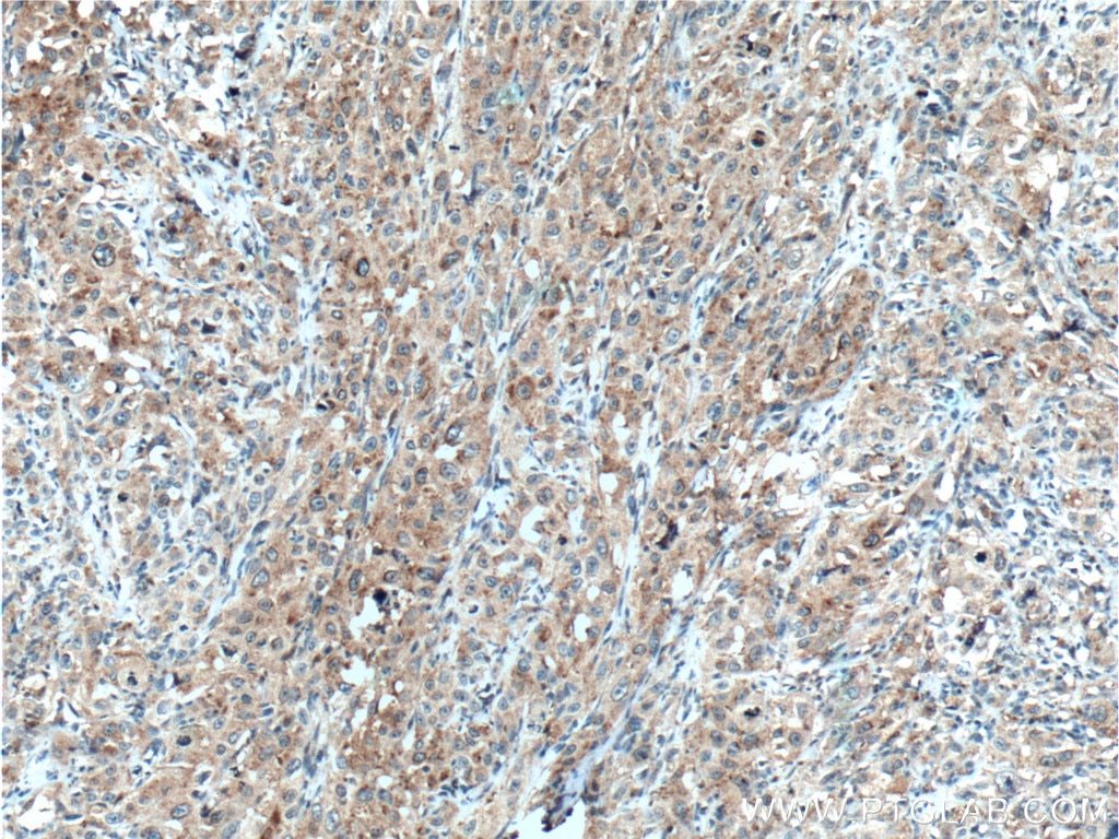 IHC staining of human cervical cancer using 16246-1-AP