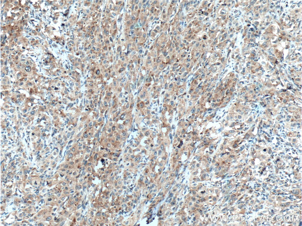 Immunohistochemistry (IHC) staining of human cervical cancer tissue using SAT2 Polyclonal antibody (16246-1-AP)