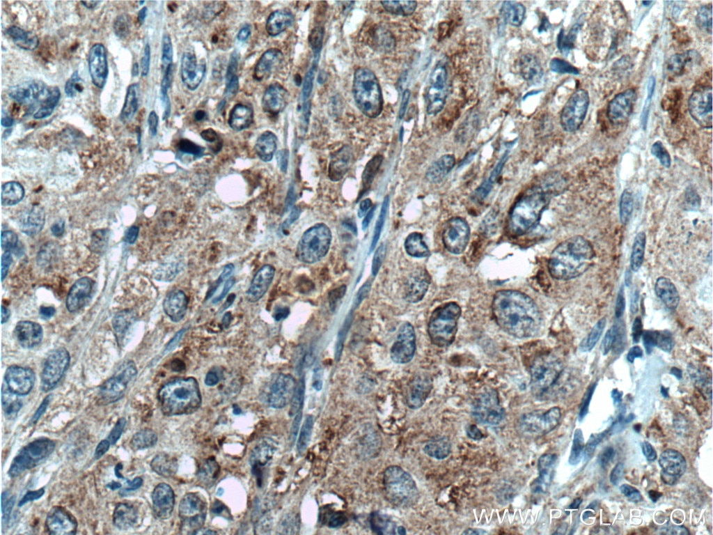 Immunohistochemistry (IHC) staining of human cervical cancer tissue using SAT2 Polyclonal antibody (16246-1-AP)