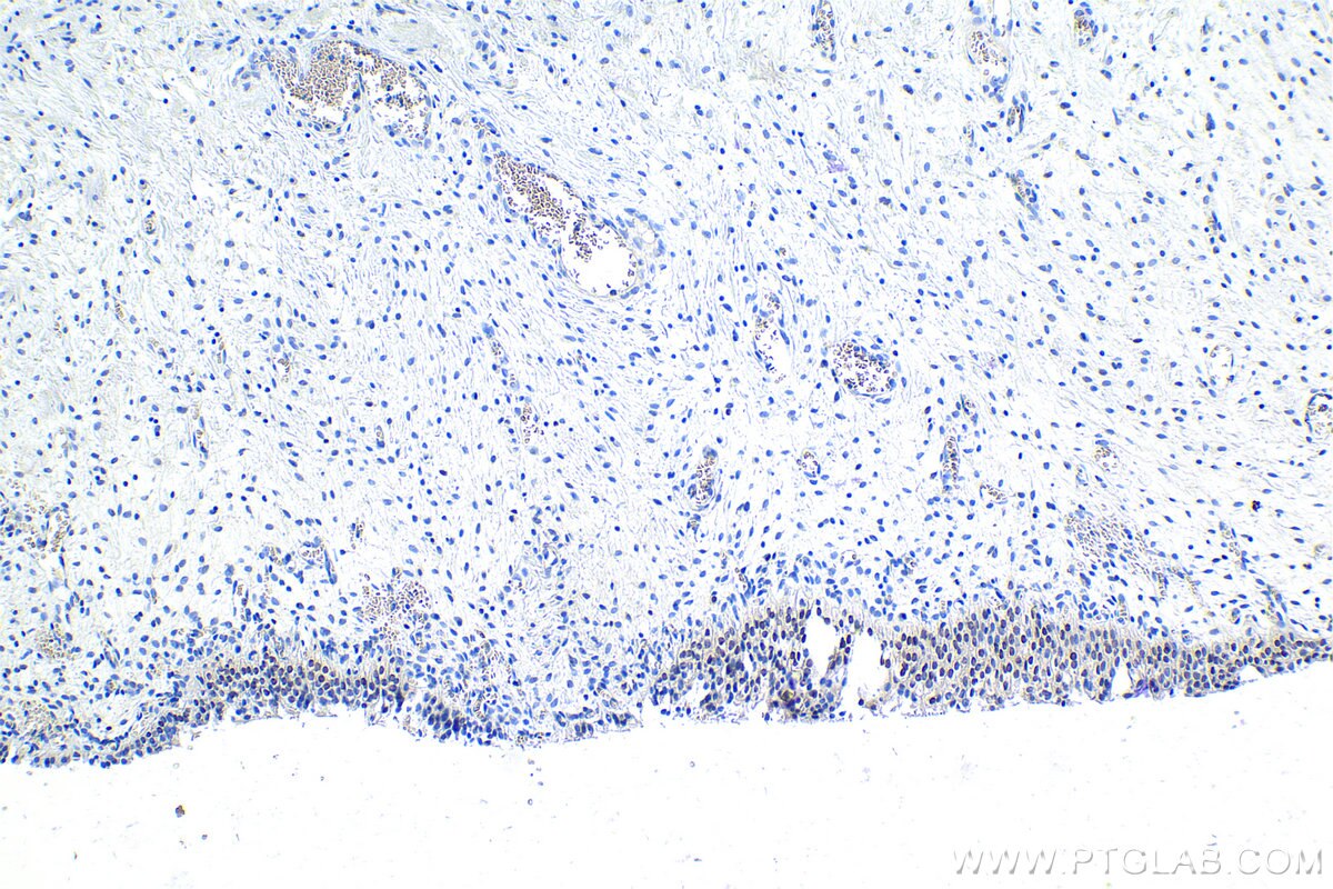 Immunohistochemistry (IHC) staining of human urothelial carcinoma tissue using SATB1 Polyclonal antibody (15400-1-AP)