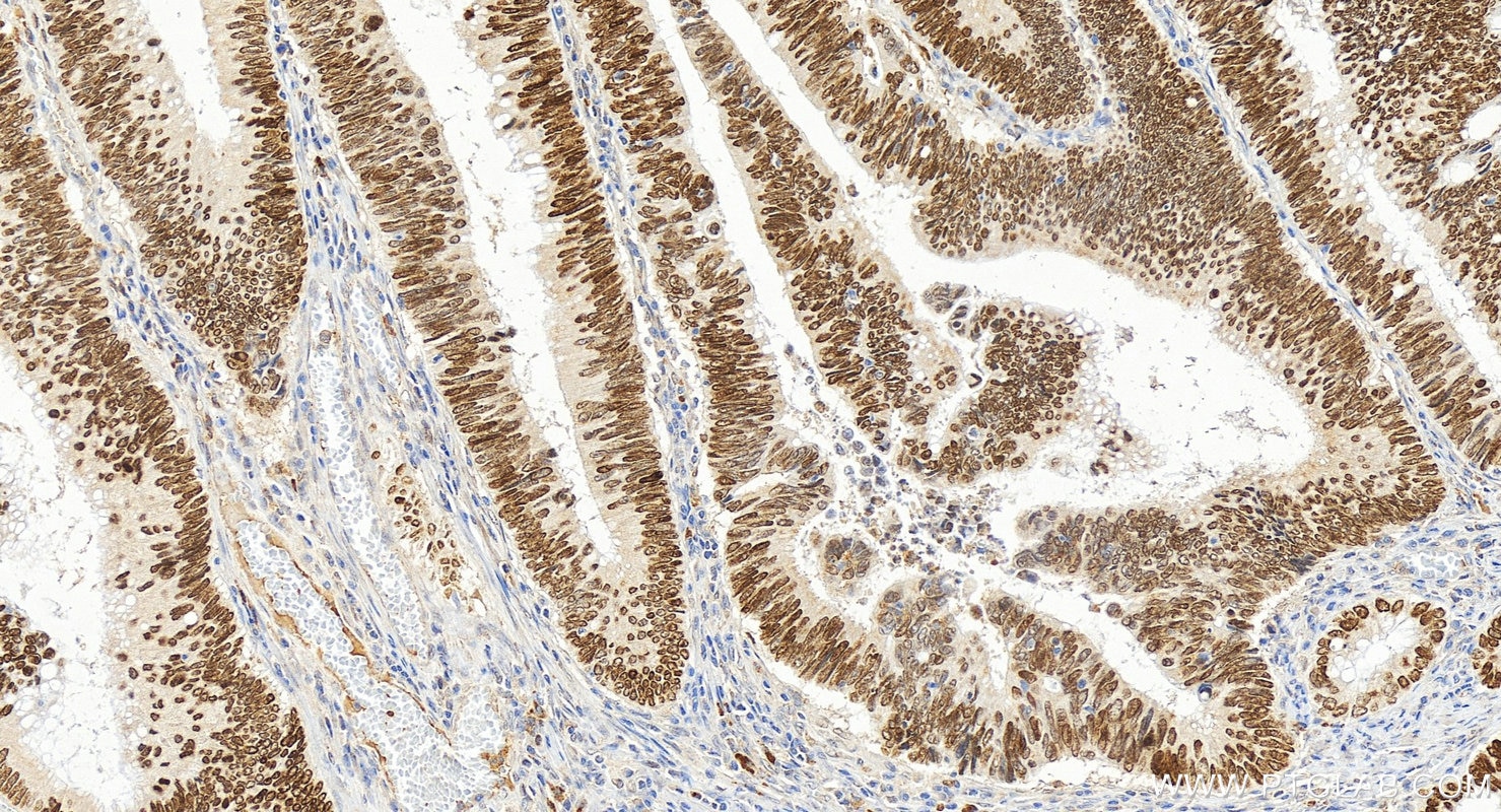 Immunohistochemistry (IHC) staining of human colon cancer tissue using SATB2 Polyclonal antibody (30717-1-AP)