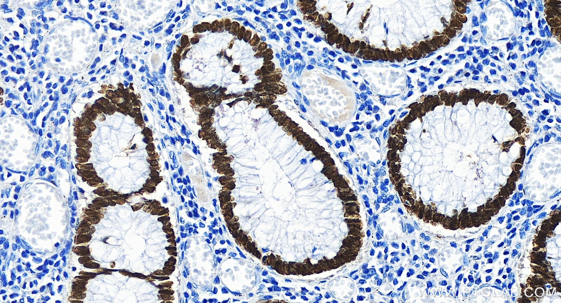 Immunohistochemistry (IHC) staining of human colon cancer tissue using SATB2 Recombinant antibody (85922-1-RR)