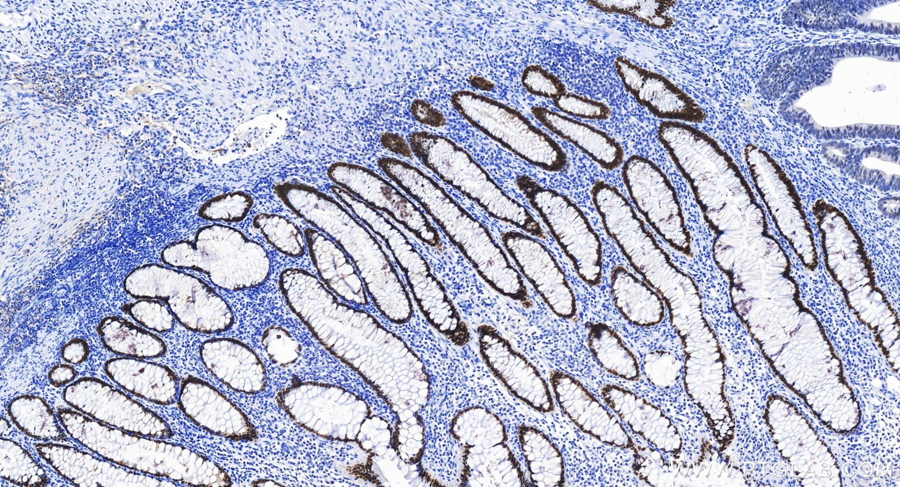 Immunohistochemistry (IHC) staining of human colon cancer tissue using SATB2 Recombinant antibody (85922-1-RR)
