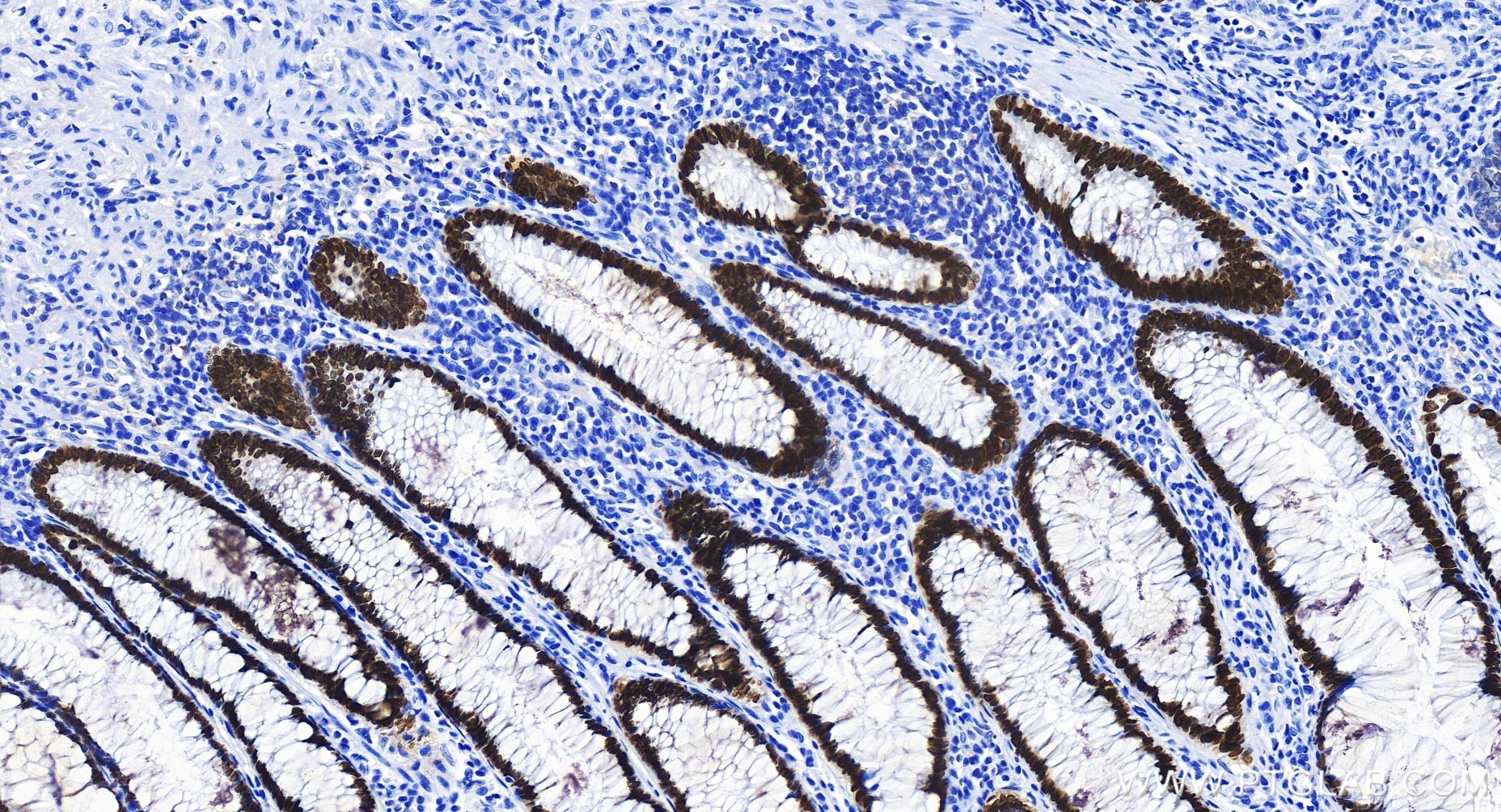 Immunohistochemistry (IHC) staining of human colon cancer tissue using SATB2 Recombinant antibody (85922-1-RR)