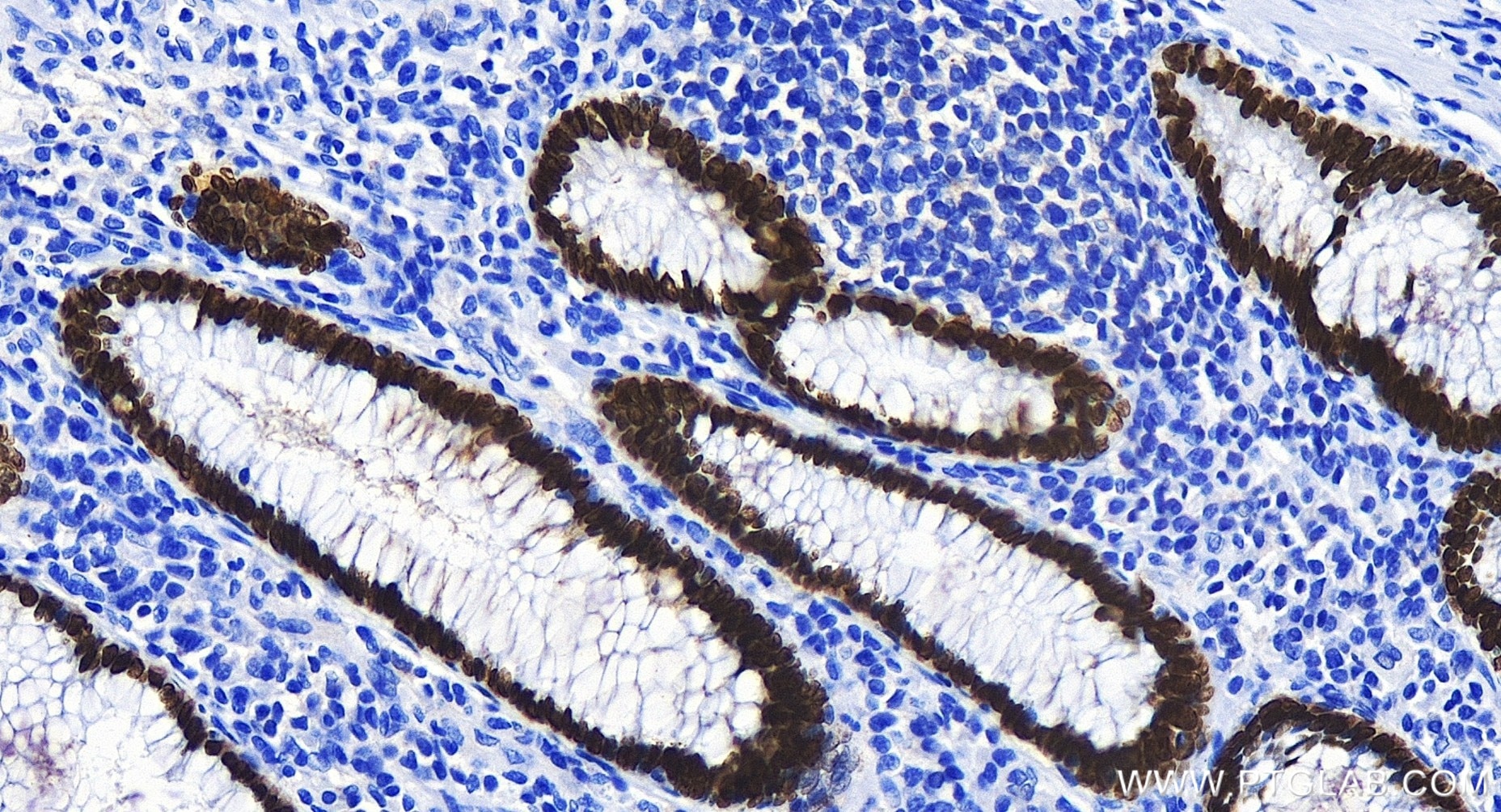 Immunohistochemistry (IHC) staining of human colon cancer tissue using SATB2 Recombinant antibody (85922-1-RR)