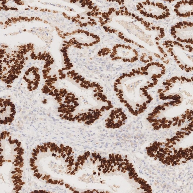 IHC staining of human colorectal cancer using 85922-1-RR Immunohistochemistry (IHC) staining of human colorectal cancer tissue using SATB2 Recombinant monoclonal antibody (85922-1-RR)