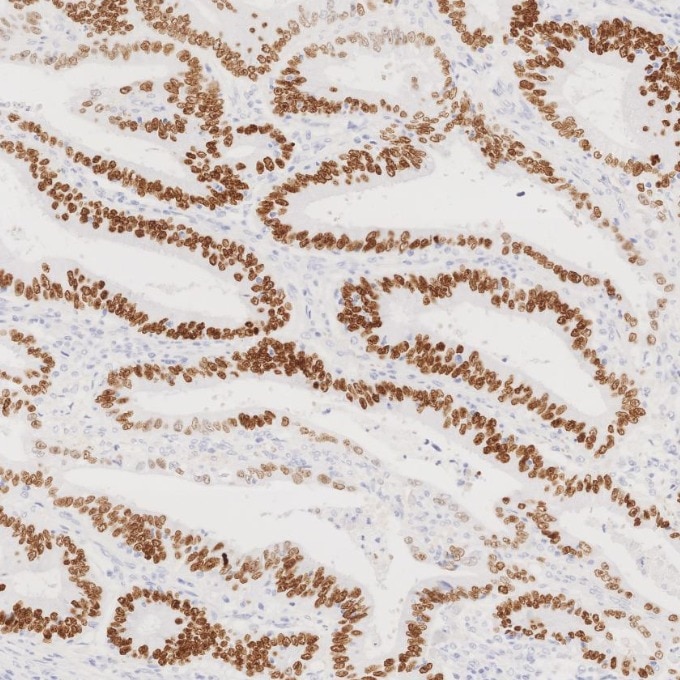 IHC staining of human colorectal cancer using 85922-1-RR Immunohistochemistry (IHC) staining of human colorectal cancer tissue using SATB2 Recombinant monoclonal antibody (85922-1-RR)