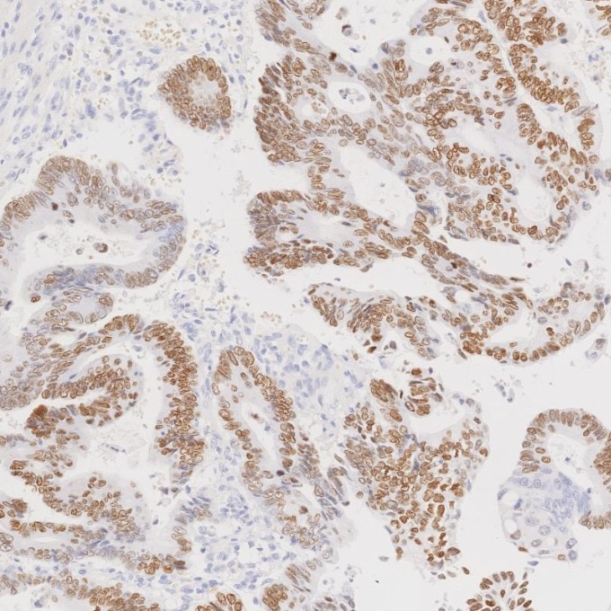 IHC staining of human colorectal cancer using 85922-1-RR Immunohistochemistry (IHC) staining of human colorectal cancer tissue using SATB2 Recombinant monoclonal antibody (85922-1-RR)