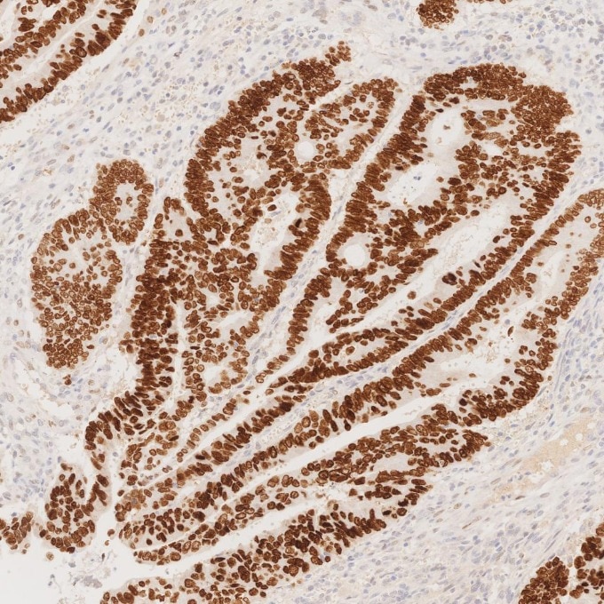 IHC staining of human colorectal cancer using 85922-1-RR Immunohistochemistry (IHC) staining of human colorectal cancer tissue using SATB2 Recombinant monoclonal antibody (85922-1-RR)