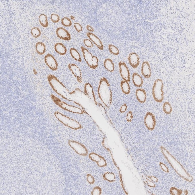 IHC staining of human appendicitis using 85922-1-RR Immunohistochemistry (IHC) staining of human appendicitis tissue using SATB2 Recombinant monoclonal antibody (85922-1-RR)