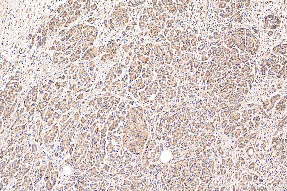 Immunohistochemistry (IHC) staining of human pancreas cancer tissue using SBDS Polyclonal antibody (17618-1-AP)