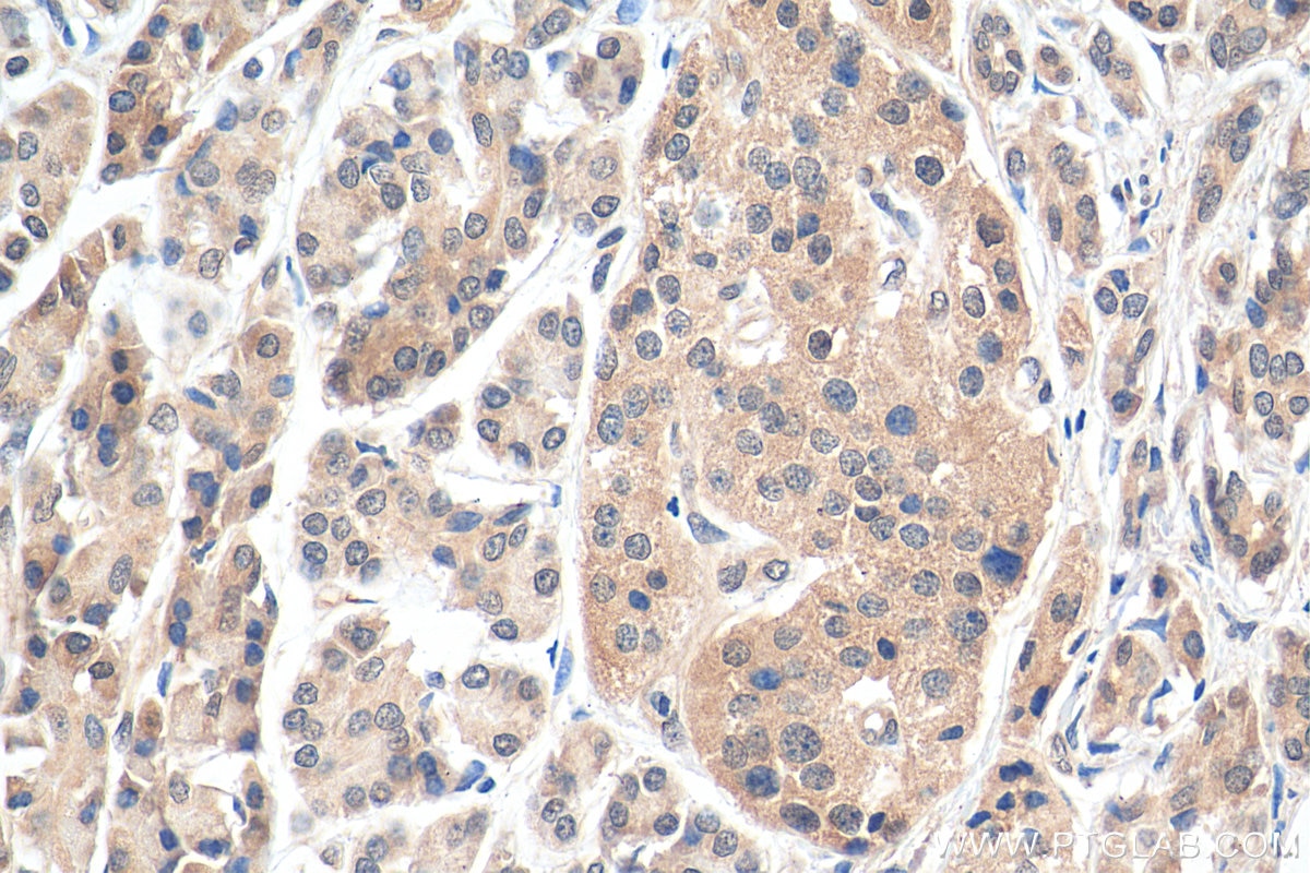 Immunohistochemistry (IHC) staining of human pancreas cancer tissue using SBDS Polyclonal antibody (17618-1-AP)