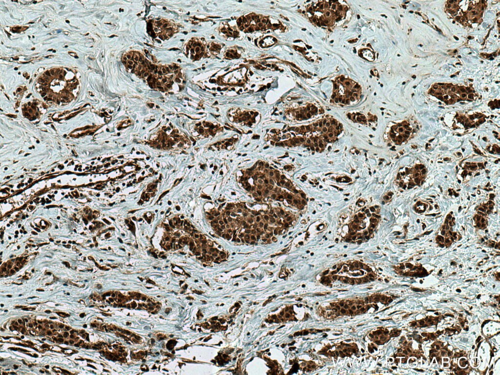 Immunohistochemistry (IHC) staining of human breast cancer tissue using SBDS Monoclonal antibody (67200-1-Ig)