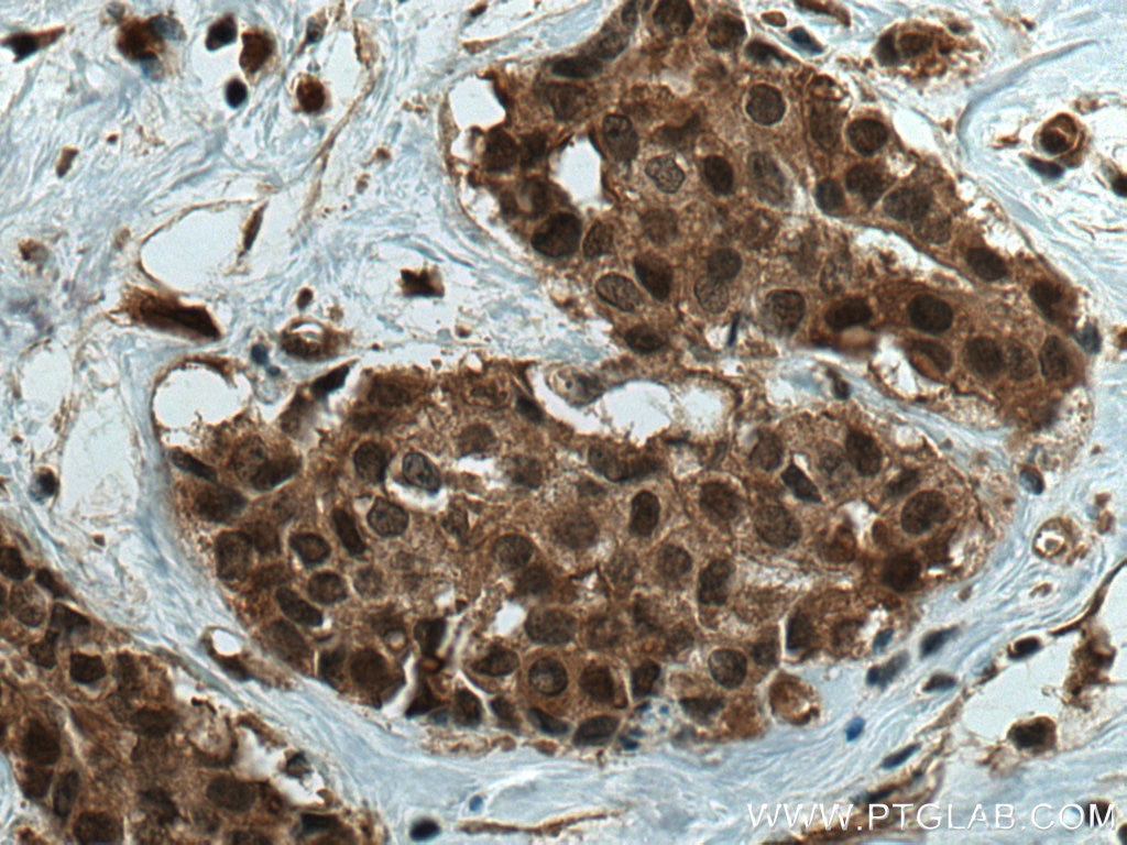 Immunohistochemistry (IHC) staining of human breast cancer tissue using SBDS Monoclonal antibody (67200-1-Ig)