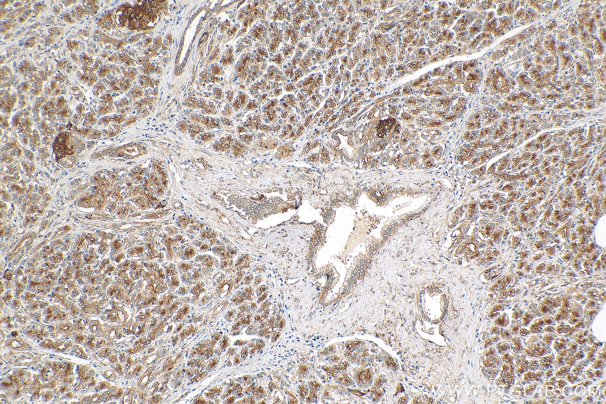 Immunohistochemistry (IHC) staining of human pancreas cancer tissue using SCAMP1 Polyclonal antibody (15327-1-AP)