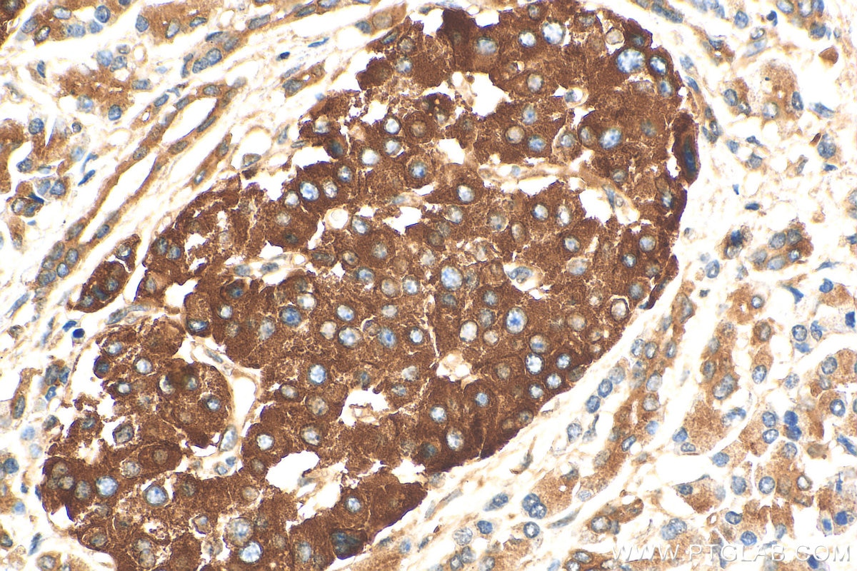 IHC staining of human pancreas cancer using 15327-1-AP