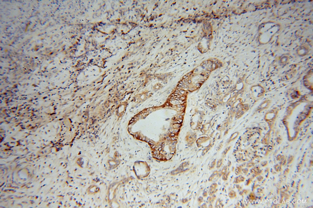 Immunohistochemistry (IHC) staining of human pancreas cancer tissue using SCAMP2 Polyclonal antibody (15119-1-AP)