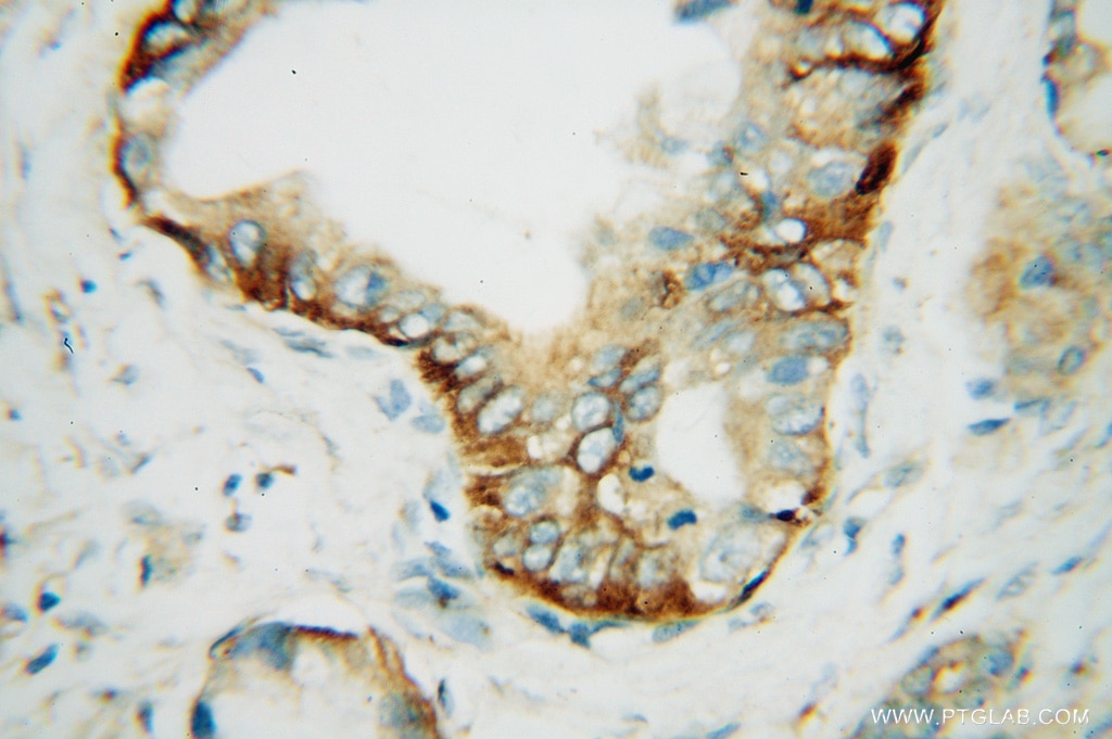 Immunohistochemistry (IHC) staining of human pancreas cancer tissue using SCAMP2 Polyclonal antibody (15119-1-AP)