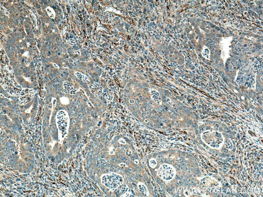 Immunohistochemistry (IHC) staining of human colon cancer tissue using SCAP Polyclonal antibody (12266-1-AP)