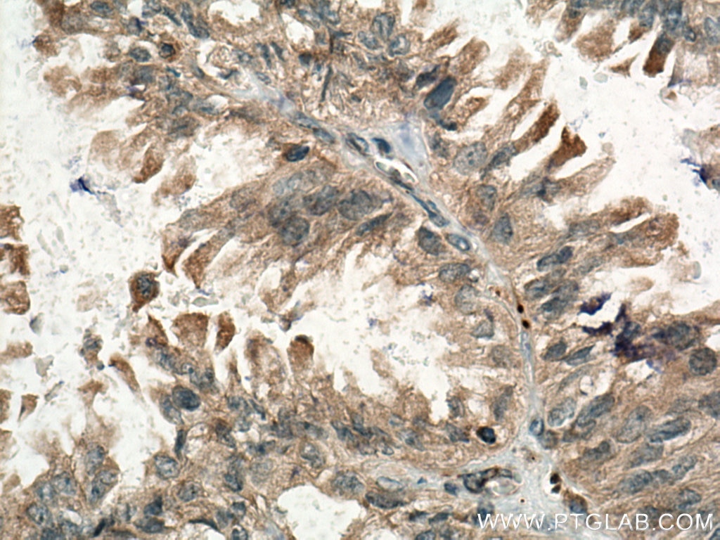 Immunohistochemistry (IHC) staining of human lung cancer tissue using SCAP Polyclonal antibody (12266-1-AP)