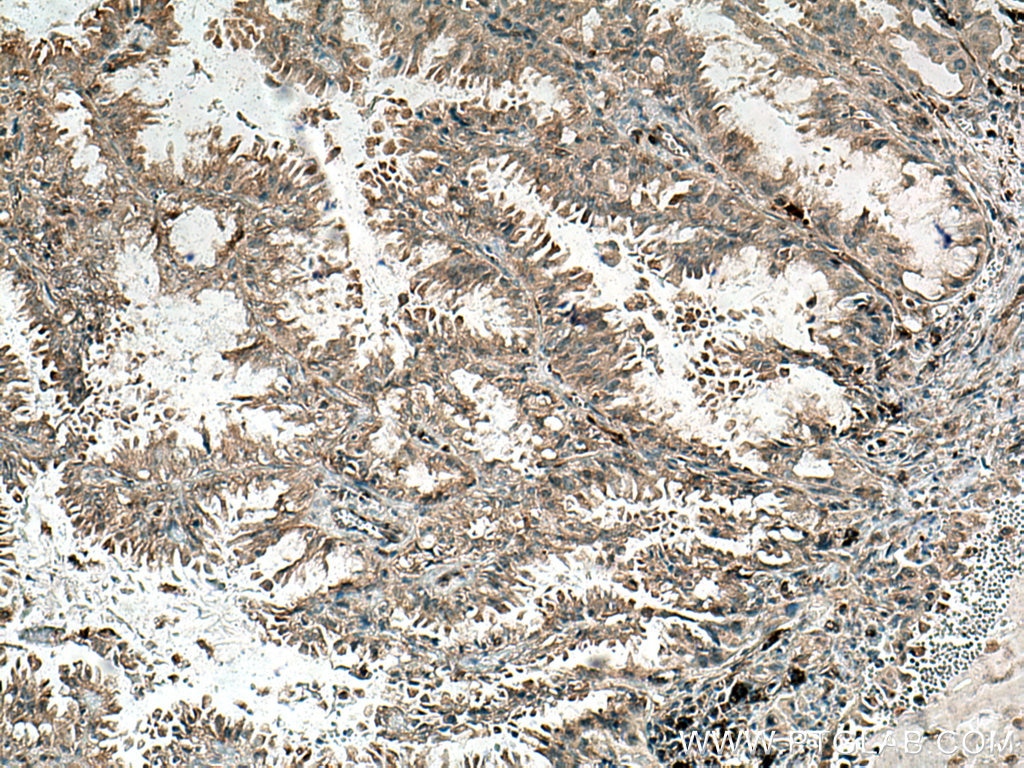 IHC staining of human lung cancer using 12266-1-AP