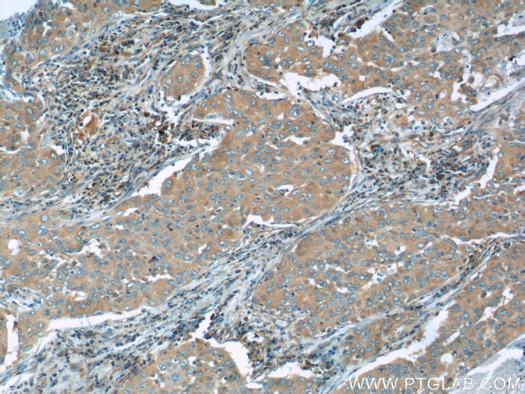 Immunohistochemistry (IHC) staining of human lung cancer tissue using SCAP Polyclonal antibody (12266-1-AP)