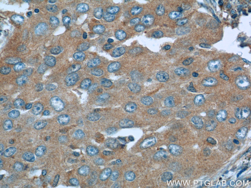 IHC staining of human lung cancer using 12266-1-AP