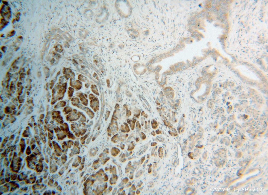Immunohistochemistry (IHC) staining of human pancreas cancer tissue using RPS4X Polyclonal antibody (14799-1-AP)