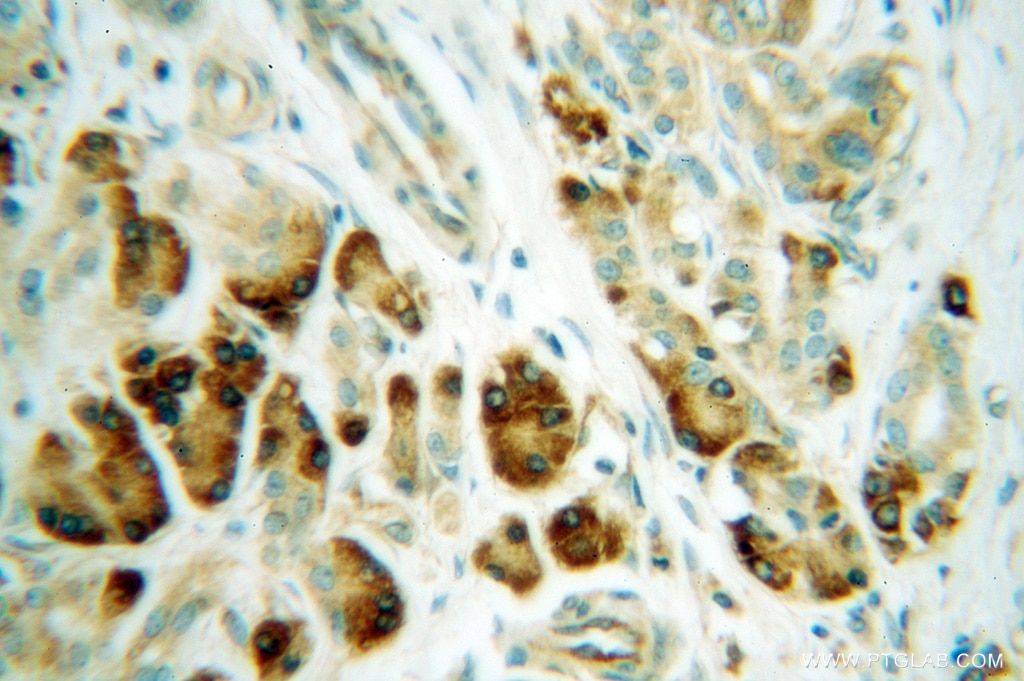 Immunohistochemistry (IHC) staining of human pancreas cancer tissue using RPS4X Polyclonal antibody (14799-1-AP)