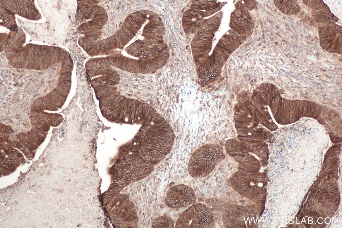 Immunohistochemistry (IHC) staining of human colon cancer tissue using SCD Polyclonal antibody (28678-1-AP)