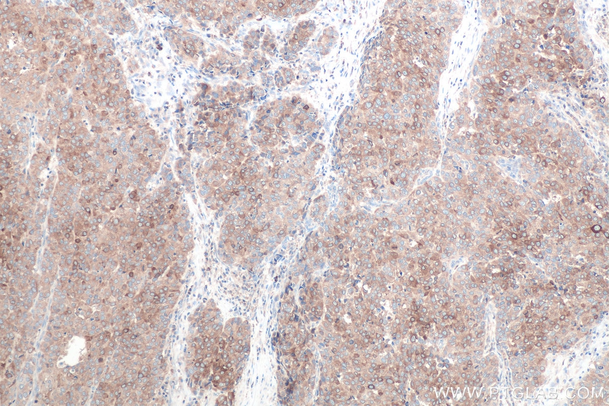 Immunohistochemistry (IHC) staining of human stomach cancer tissue using SCD Polyclonal antibody (28678-1-AP)