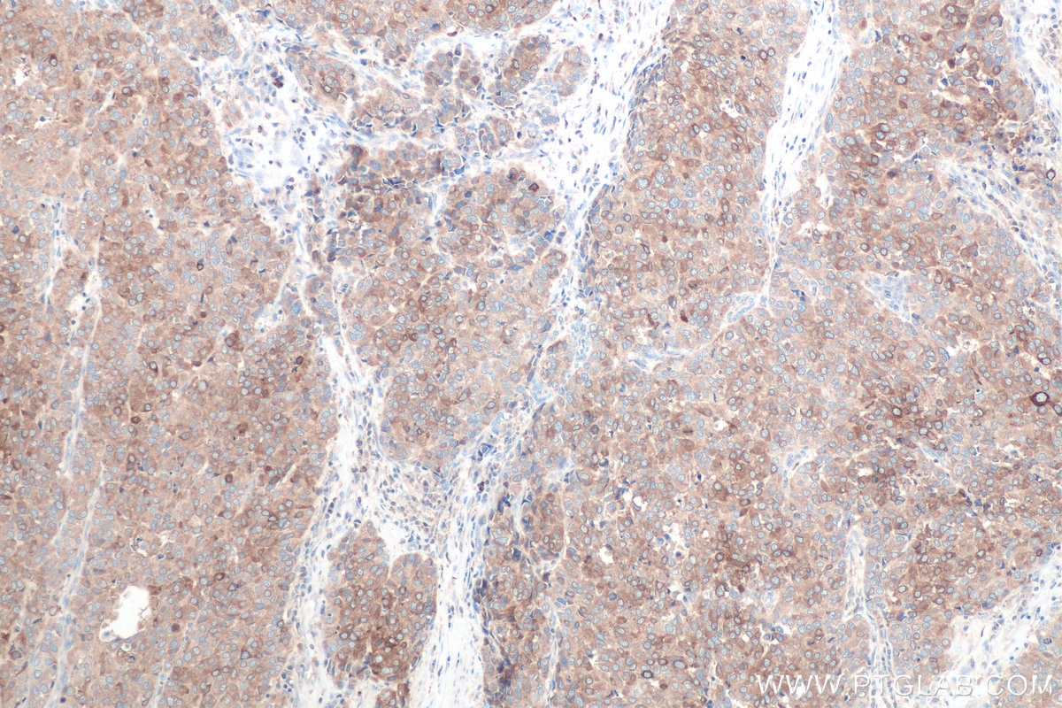 IHC staining of human stomach cancer using 28678-1-AP