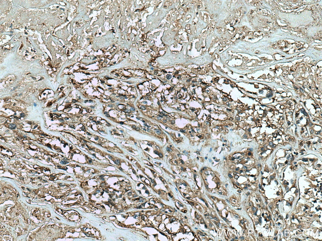 Immunohistochemistry (IHC) staining of human renal cell carcinoma tissue using SCEL Polyclonal antibody (11906-1-AP)